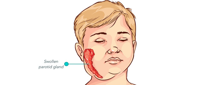 مضاعفات الغدة النكافية انتبه لها