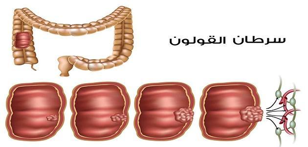 مضاعفات سرطان القولون