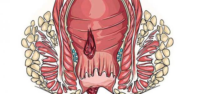 معلومات عن الناسور الشرجي