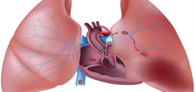 معلومات عن انسداد الشريان الرئوي