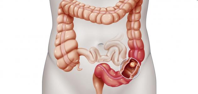 معلومات عن سرطان المستقيم