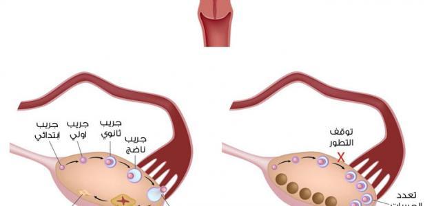 هل اضطراب الدورة يؤخر الحمل