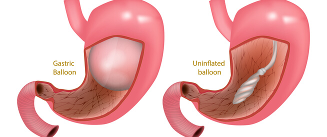 هل تعرف أضرار بالون المعدة؟