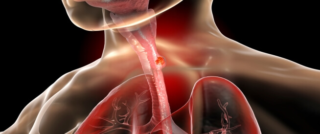 هل سرطان المريء خطير؟ إليك الإجابة