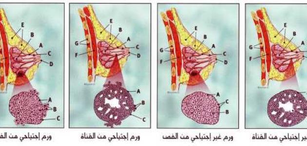 ورم خبيث في الثدي