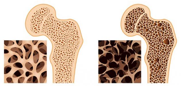 وصفة طبيعية لعلاج هشاشة العظام
